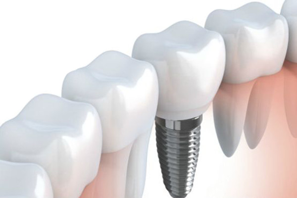 Clínica dental Alcalá de Henares destaca beneficios en implantología